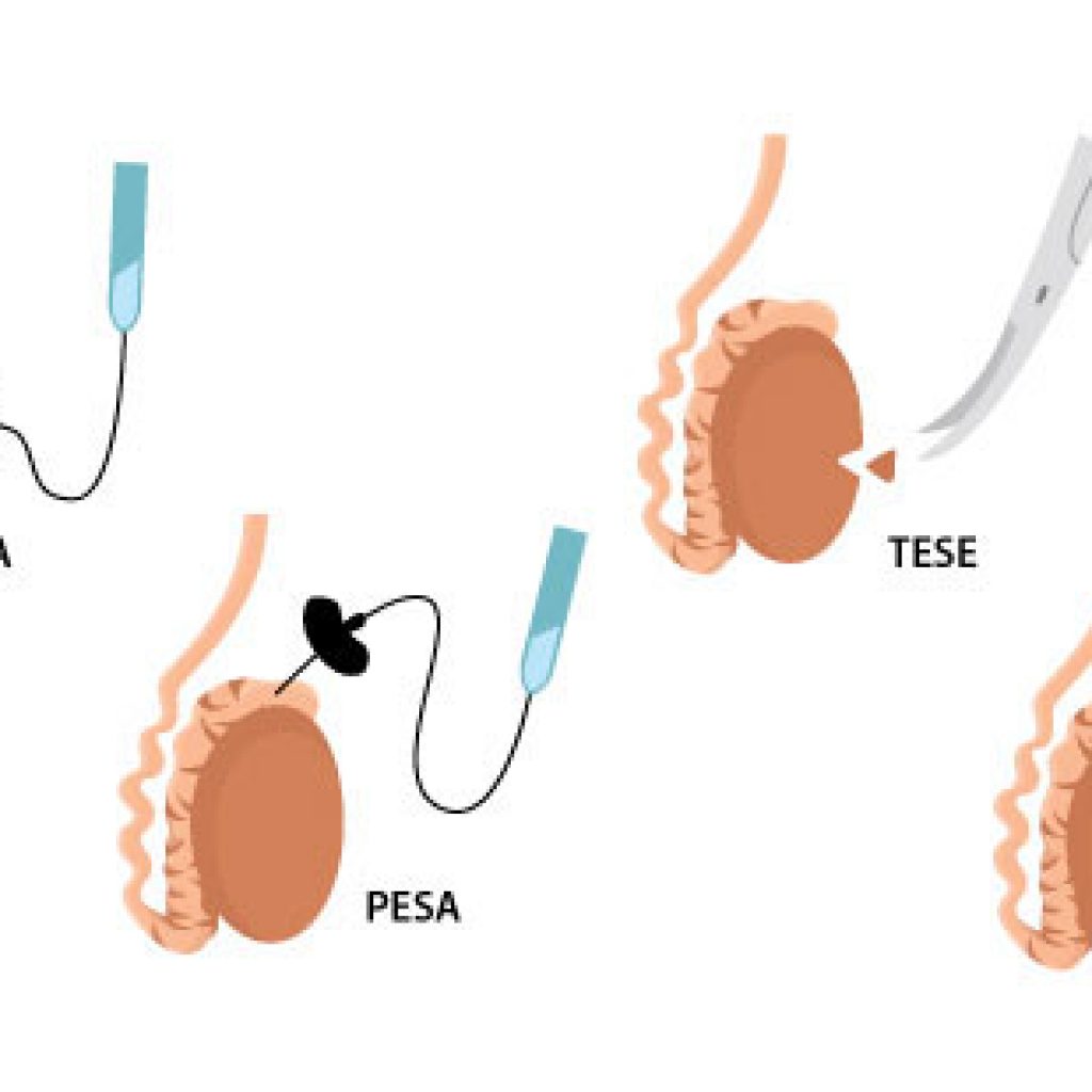 Phương pháp điều trị vô sinh nam hiệu quả bằng pp MESA
