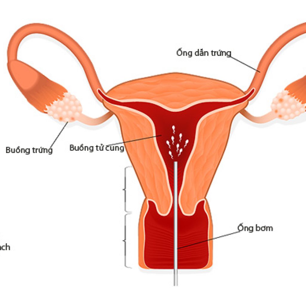 Phương pháp bơm tinh trùng vào buồng tử cung IUI