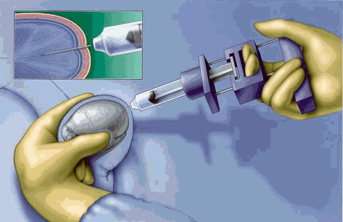 Phương pháp lấy tinh trùng từ mào tinh hoàn bằng vi phẫu MESA
